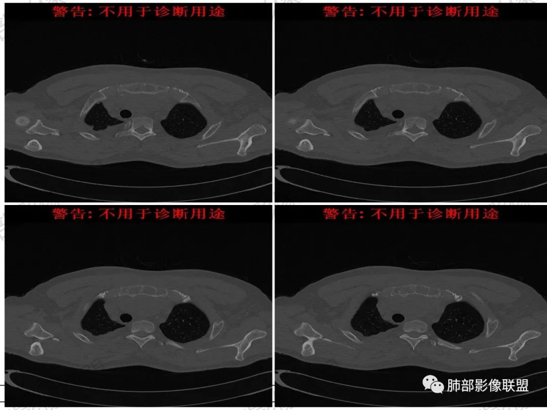 影像PPT - 【病例】 肉包骨,是骨淋巴瘤的特征吗?-34 影像PPT - 【病例】 肉包骨,是骨淋巴瘤的特征吗?-34