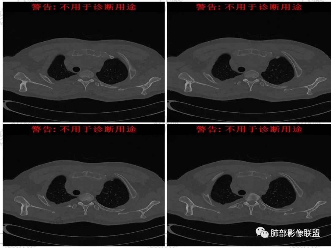 影像PPT - 【病例】 肉包骨,是骨淋巴瘤的特征吗?-35 影像PPT - 【病例】 肉包骨,是骨淋巴瘤的特征吗?-35