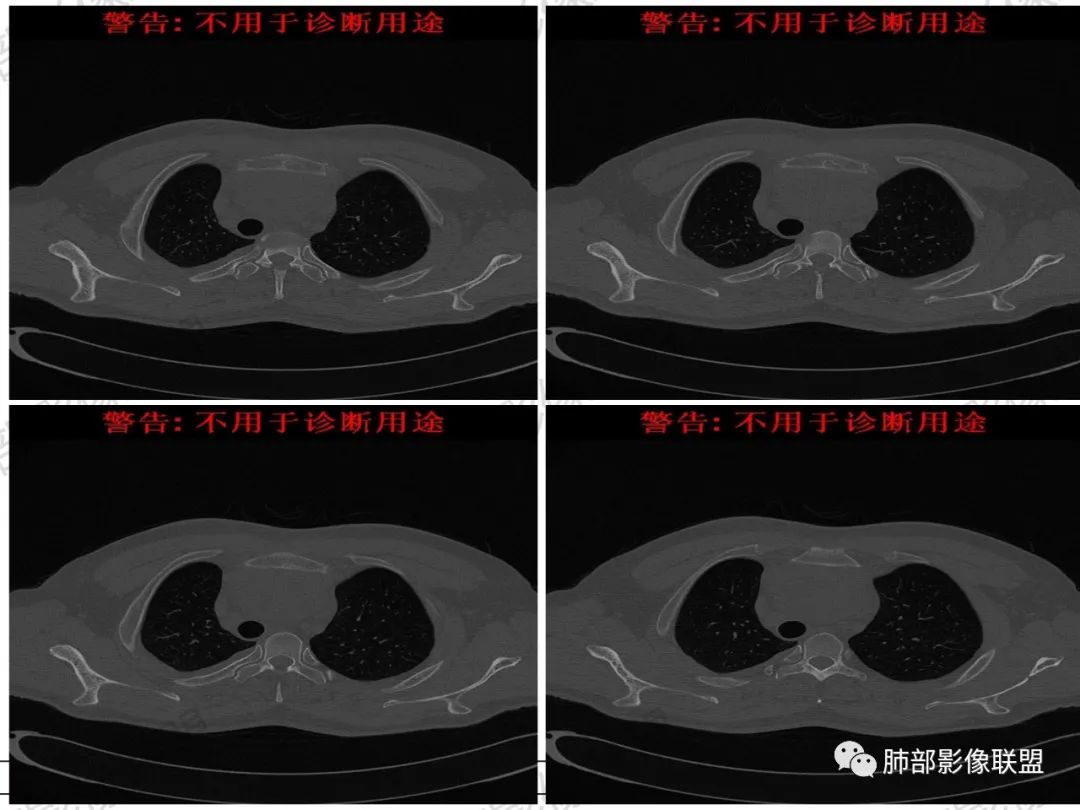 影像PPT - 【病例】 肉包骨,是骨淋巴瘤的特征吗?-36 影像PPT - 【病例】 肉包骨,是骨淋巴瘤的特征吗?-36