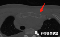 影像PPT - 【病例】 肉包骨,是骨淋巴瘤的特征吗?-40 影像PPT - 【病例】 肉包骨,是骨淋巴瘤的特征吗?-40