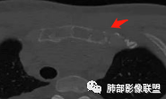 影像PPT - 【病例】 肉包骨,是骨淋巴瘤的特征吗?-41 影像PPT - 【病例】 肉包骨,是骨淋巴瘤的特征吗?-41
