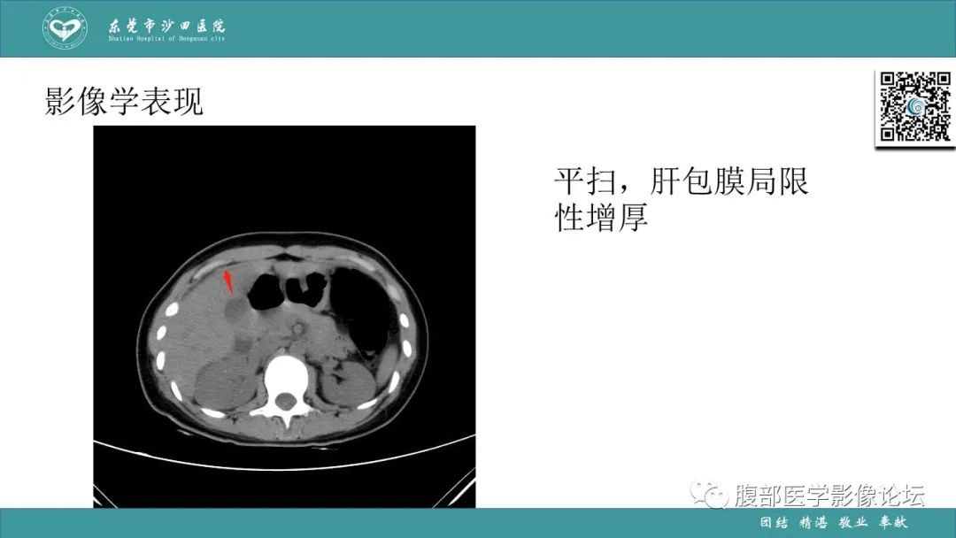 影像PPT - 【PPT】Fitz-Hugh-Curtis综合征 (FHCS)-35
