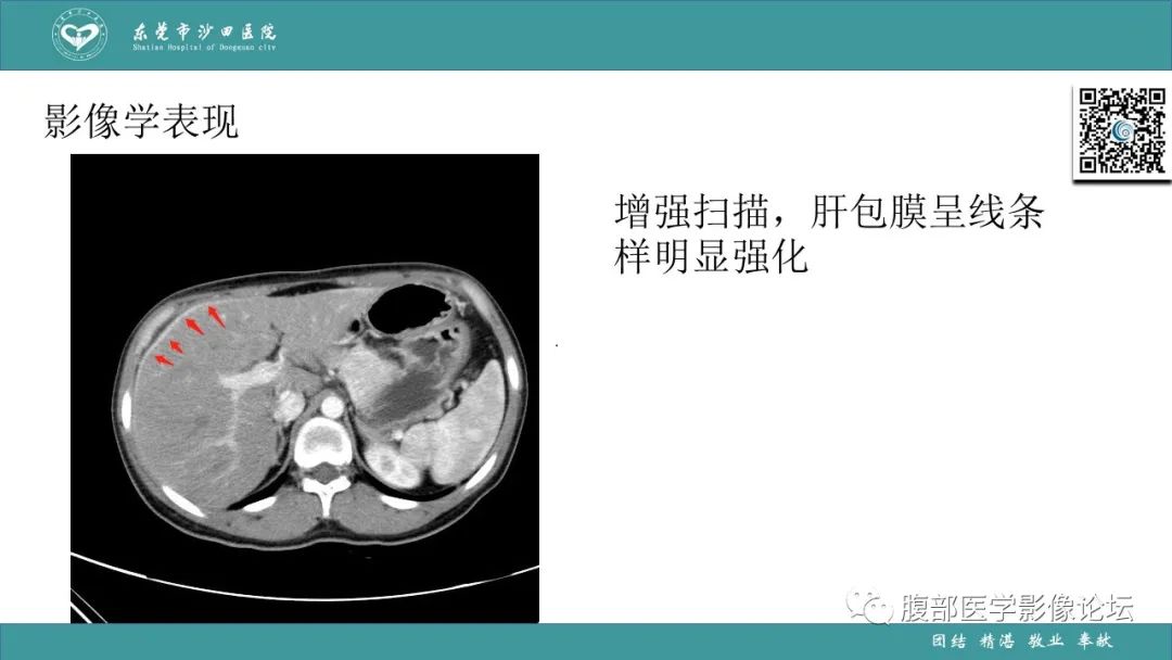 影像PPT - 【PPT】Fitz-Hugh-Curtis综合征 (FHCS)-36