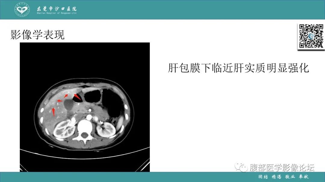 影像PPT - 【PPT】Fitz-Hugh-Curtis综合征 (FHCS)-37