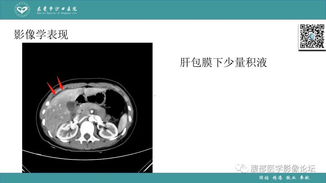 影像PPT - 【PPT】Fitz-Hugh-Curtis综合征 (FHCS)-38