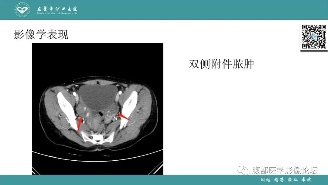 影像PPT - 【PPT】Fitz-Hugh-Curtis综合征 (FHCS)-39