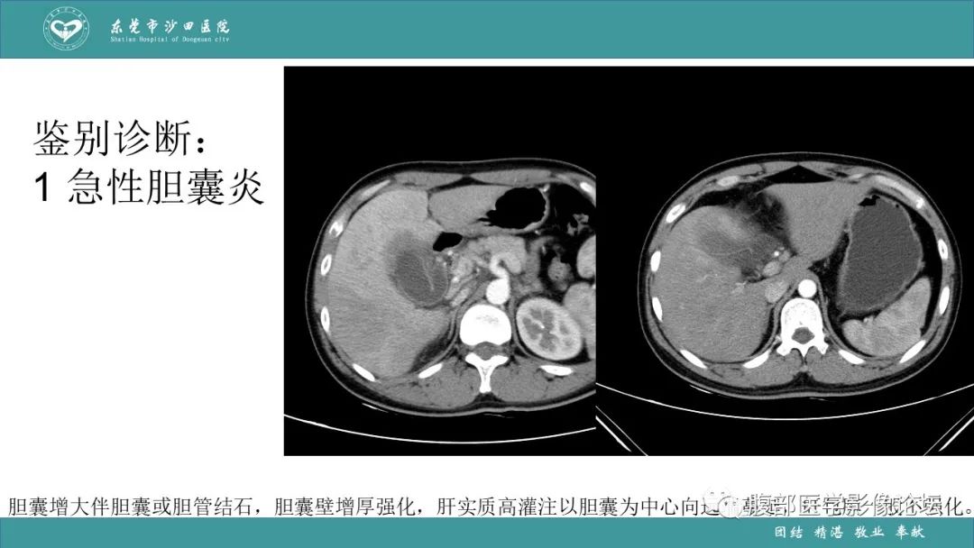 影像PPT - 【PPT】Fitz-Hugh-Curtis综合征 (FHCS)-40