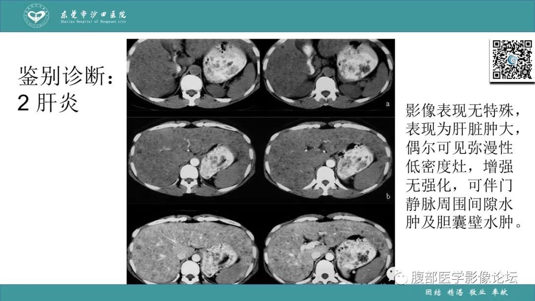 影像PPT - 【PPT】Fitz-Hugh-Curtis综合征 (FHCS)-41