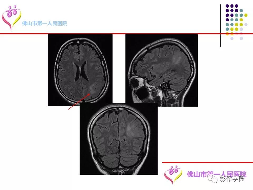 影像PPT - 【PPT】脑皮层区病变诊断及鉴别鉴别-6