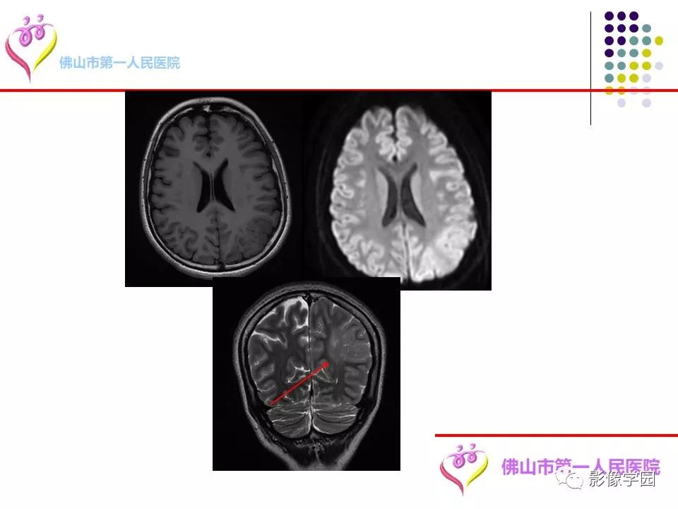影像PPT - 【PPT】脑皮层区病变诊断及鉴别鉴别-7
