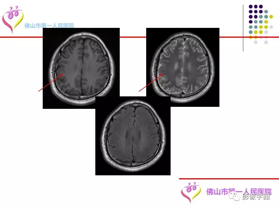 影像PPT - 【PPT】脑皮层区病变诊断及鉴别鉴别-11