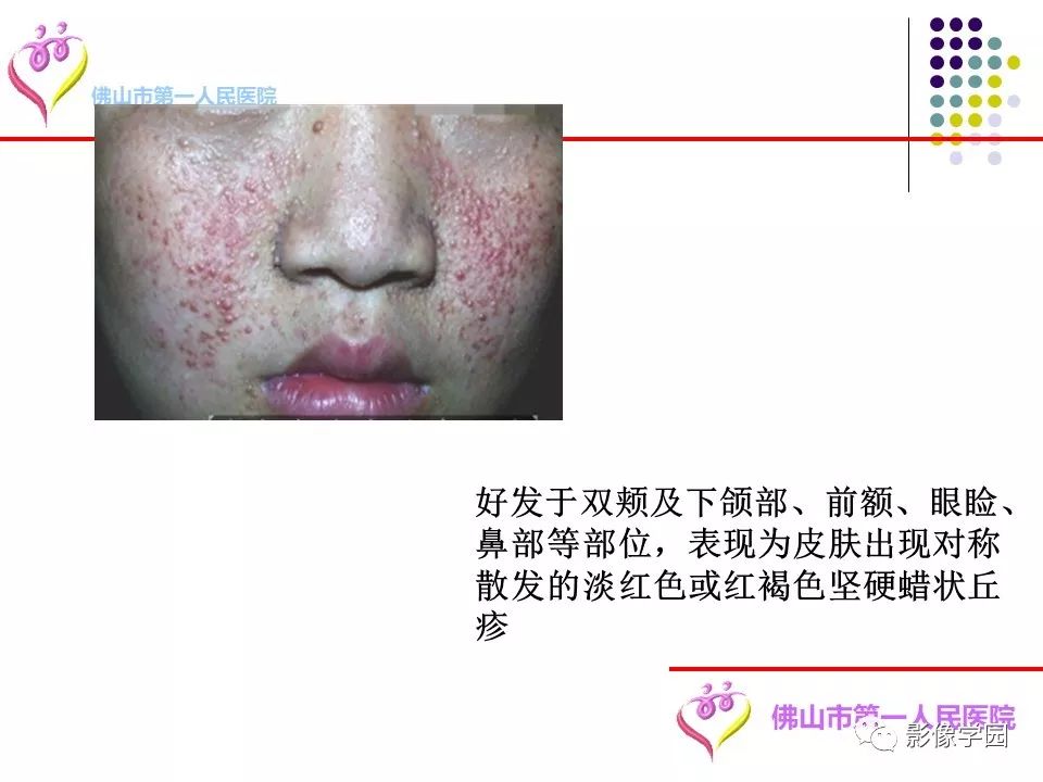影像PPT - 【PPT】脑皮层区病变诊断及鉴别鉴别-14