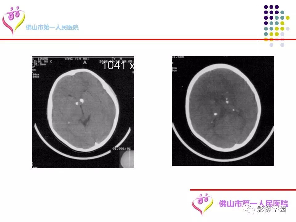 影像PPT - 【PPT】脑皮层区病变诊断及鉴别鉴别-15