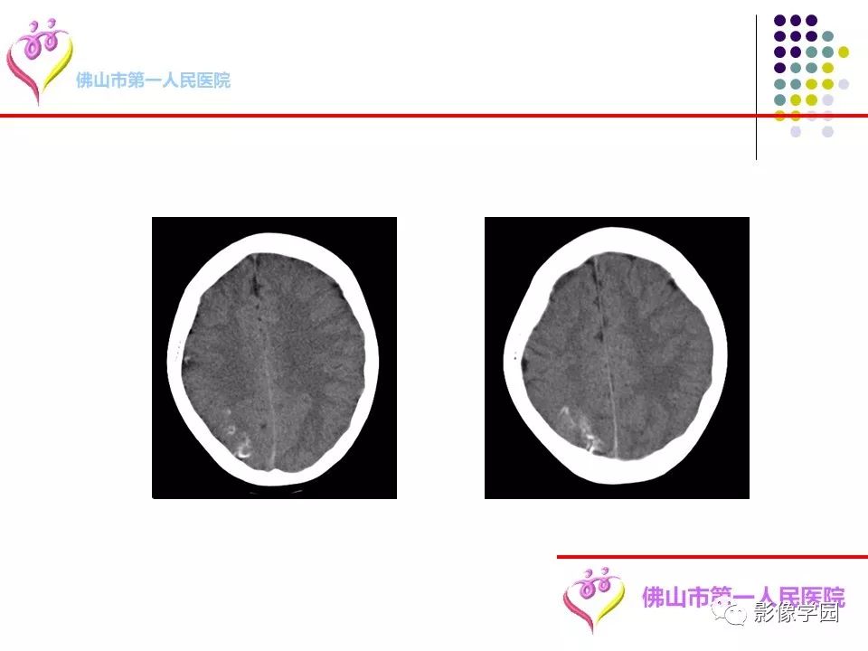 影像PPT - 【PPT】脑皮层区病变诊断及鉴别鉴别-20