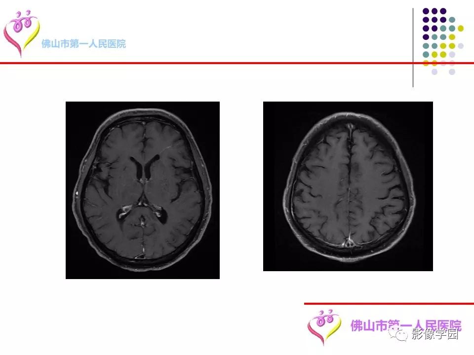 影像PPT - 【PPT】脑皮层区病变诊断及鉴别鉴别-30