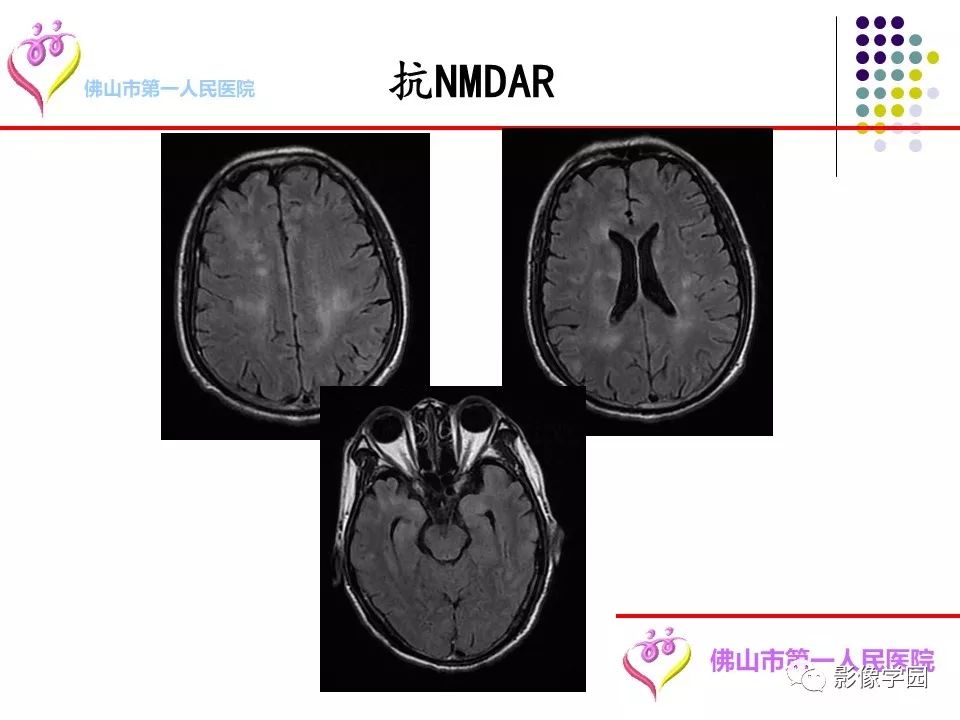 影像PPT - 【PPT】脑皮层区病变诊断及鉴别鉴别-35