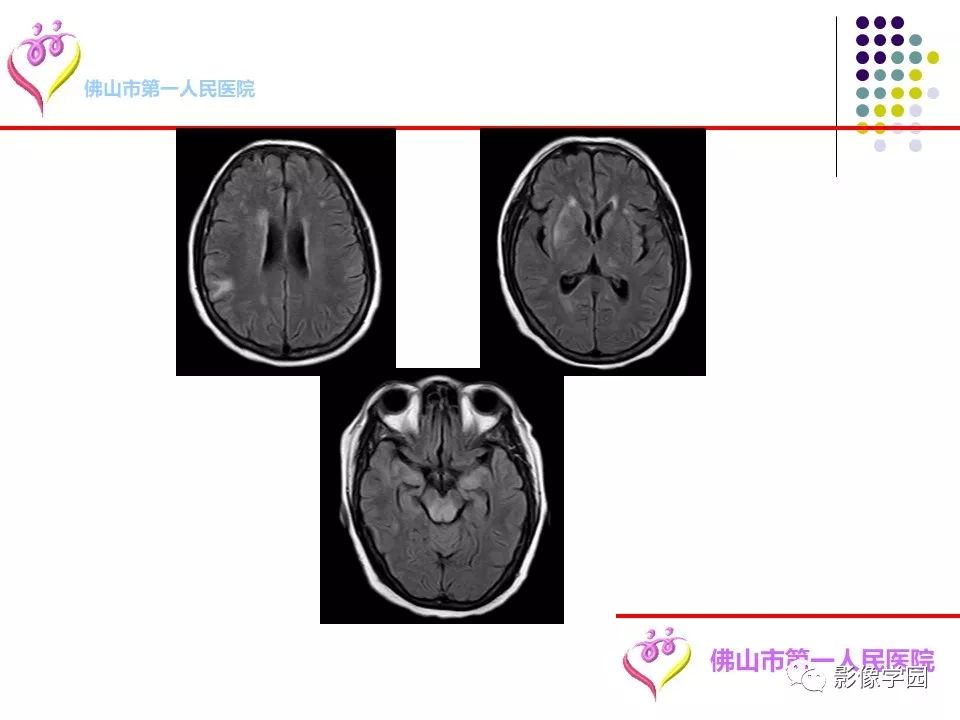 影像PPT - 【PPT】脑皮层区病变诊断及鉴别鉴别-38