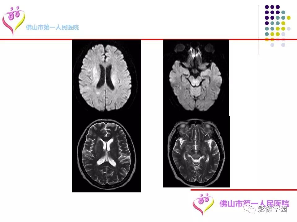 影像PPT - 【PPT】脑皮层区病变诊断及鉴别鉴别-39