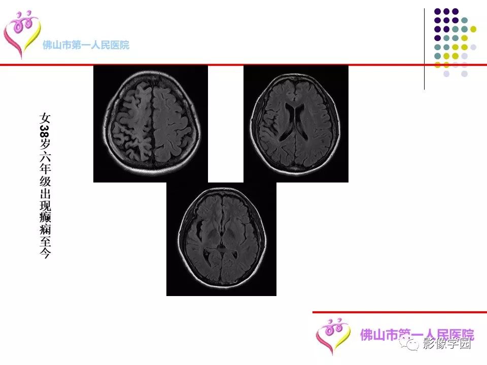 影像PPT - 【PPT】脑皮层区病变诊断及鉴别鉴别-42