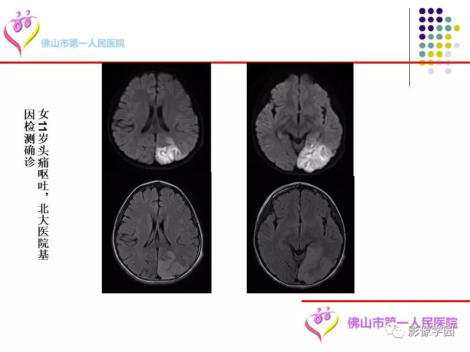影像PPT - 【PPT】脑皮层区病变诊断及鉴别鉴别-47