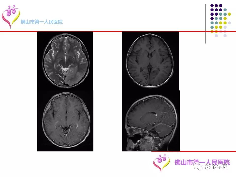 影像PPT - 【PPT】脑皮层区病变诊断及鉴别鉴别-48