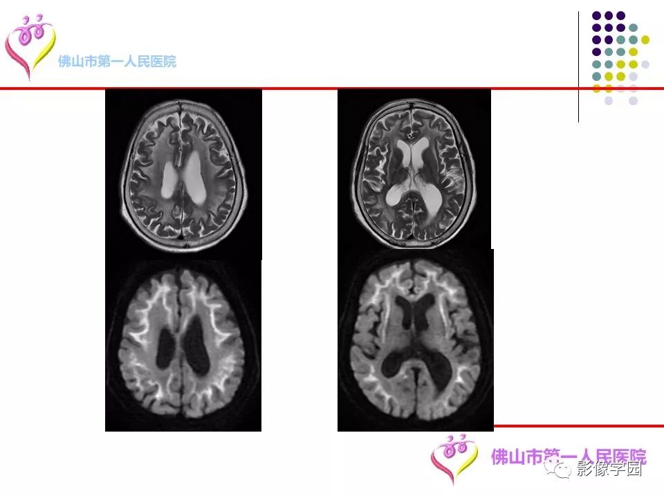 影像PPT - 【PPT】脑皮层区病变诊断及鉴别鉴别-51