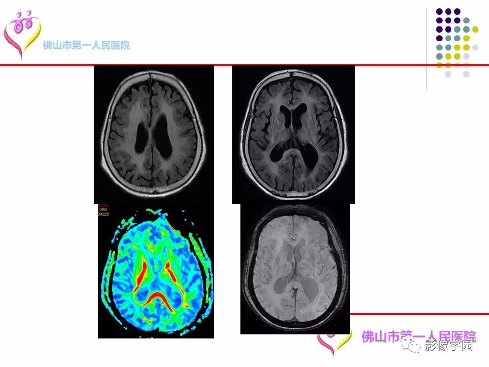 影像PPT - 【PPT】脑皮层区病变诊断及鉴别鉴别-52