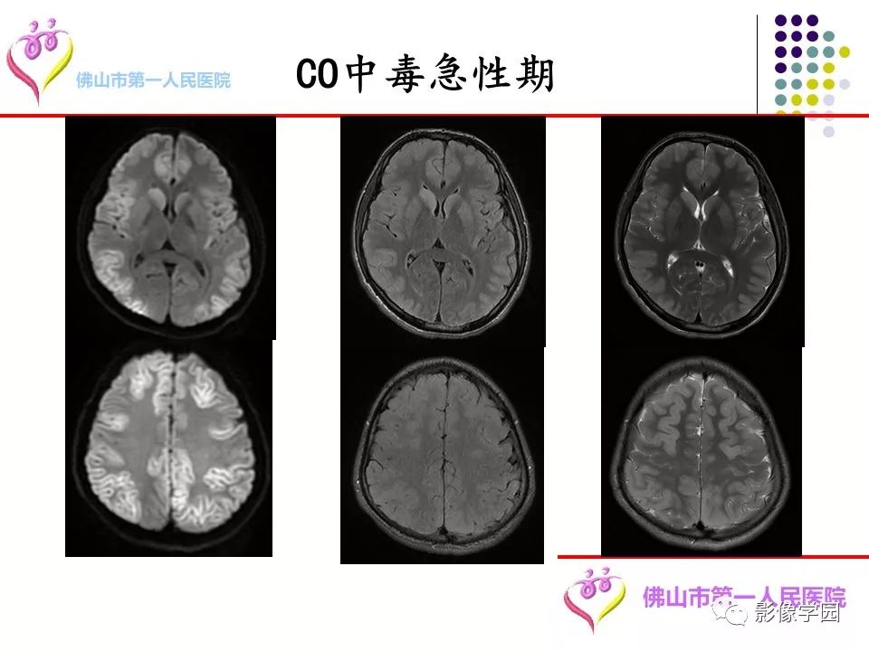 影像PPT - 【PPT】脑皮层区病变诊断及鉴别鉴别-57