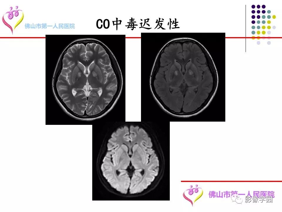 影像PPT - 【PPT】脑皮层区病变诊断及鉴别鉴别-58