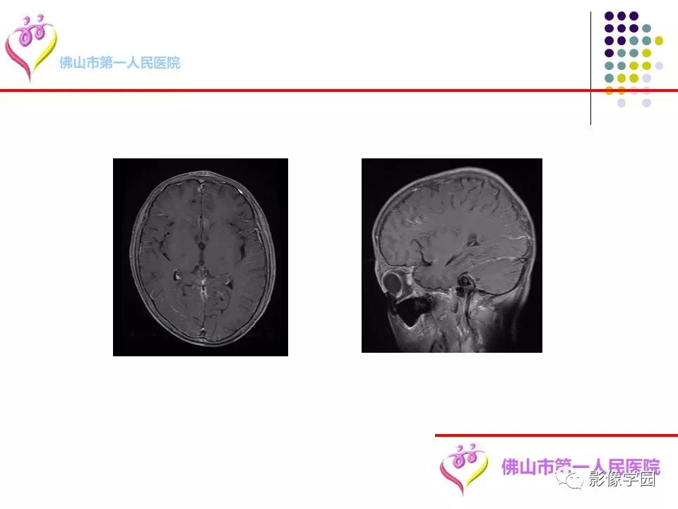 影像PPT - 【PPT】脑皮层区病变诊断及鉴别鉴别-61