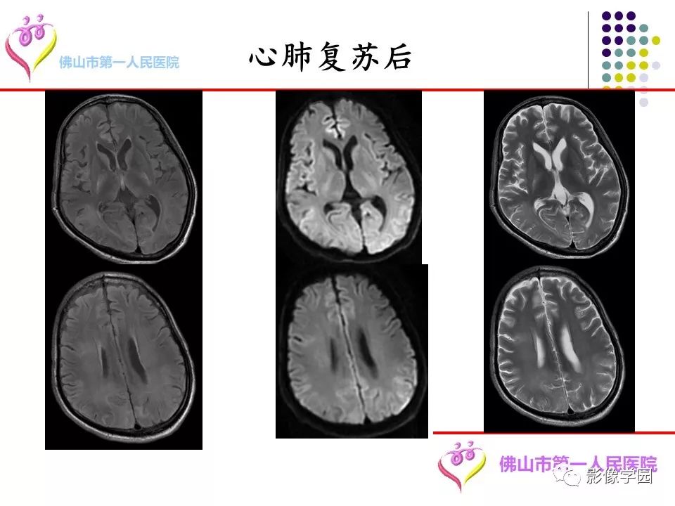 影像PPT - 【PPT】脑皮层区病变诊断及鉴别鉴别-63