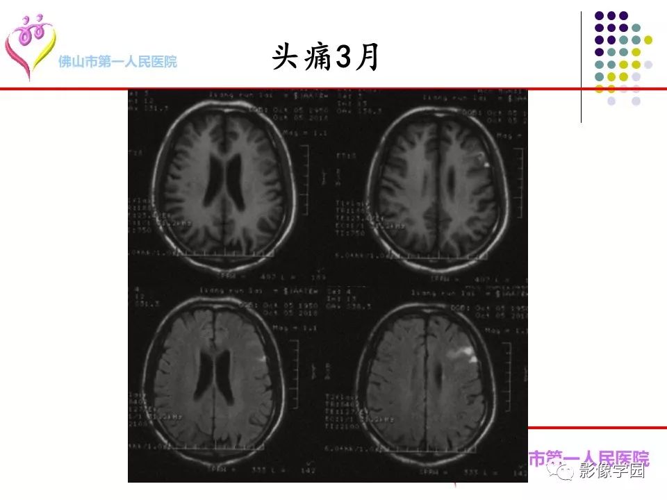 影像PPT - 【PPT】脑皮层区病变诊断及鉴别鉴别-66
