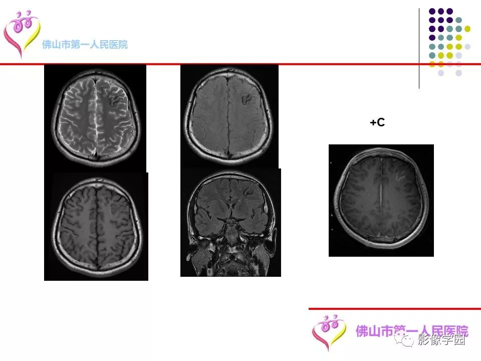 影像PPT - 【PPT】脑皮层区病变诊断及鉴别鉴别-69