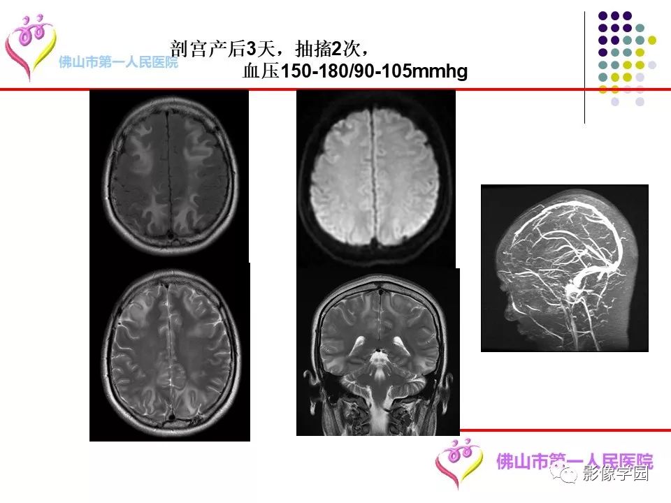 影像PPT - 【PPT】脑皮层区病变诊断及鉴别鉴别-72