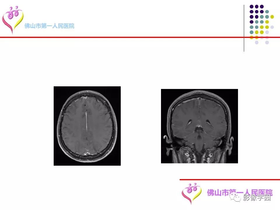 影像PPT - 【PPT】脑皮层区病变诊断及鉴别鉴别-73