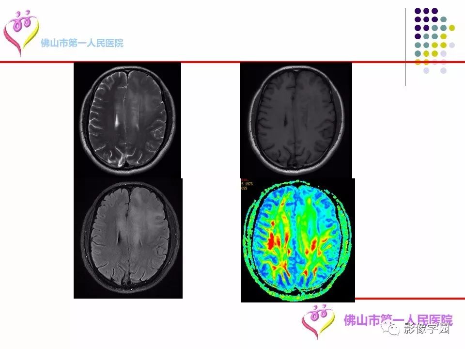 影像PPT - 【PPT】脑皮层区病变诊断及鉴别鉴别-83