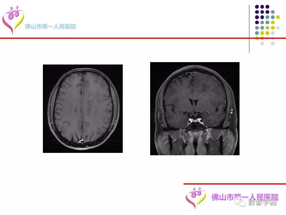 影像PPT - 【PPT】脑皮层区病变诊断及鉴别鉴别-84