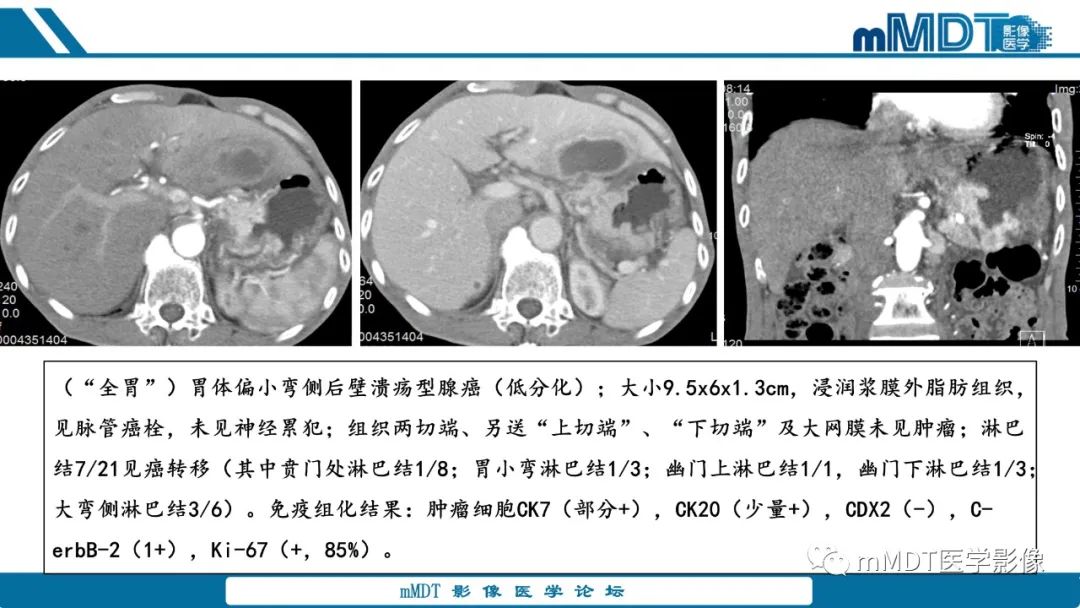 影像PPT - 【病例】胃神经鞘瘤1例CT读片分析-13