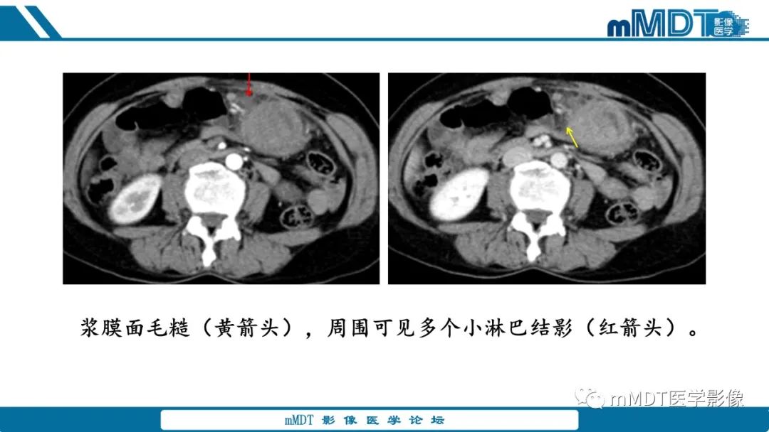 影像PPT - 【病例】胃神经鞘瘤1例CT读片分析-9