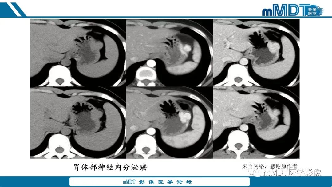 影像PPT - 【病例】胃神经鞘瘤1例CT读片分析-15