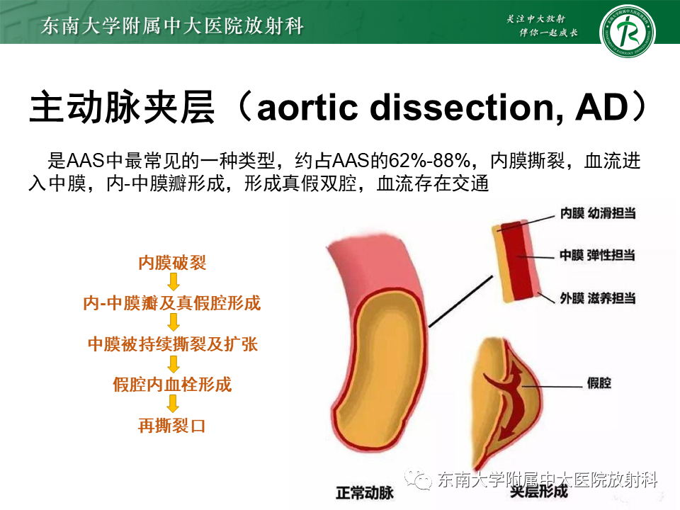 影像PPT - 【PPT】急性主动脉综合征-4