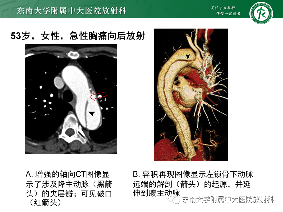 影像PPT - 【PPT】急性主动脉综合征-9