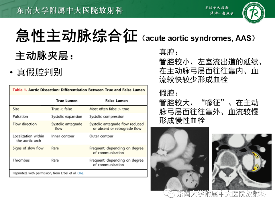影像PPT - 【PPT】急性主动脉综合征-10
