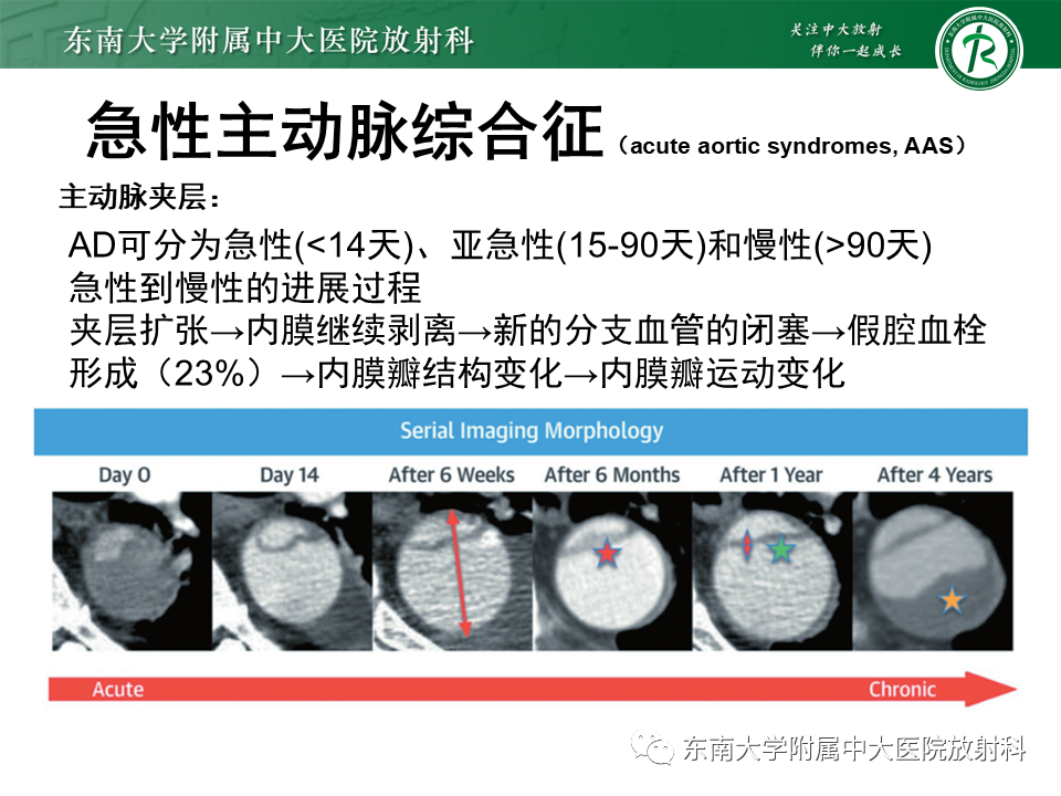 影像PPT - 【PPT】急性主动脉综合征-6