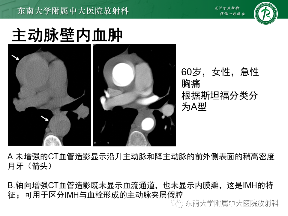 影像PPT - 【PPT】急性主动脉综合征-15