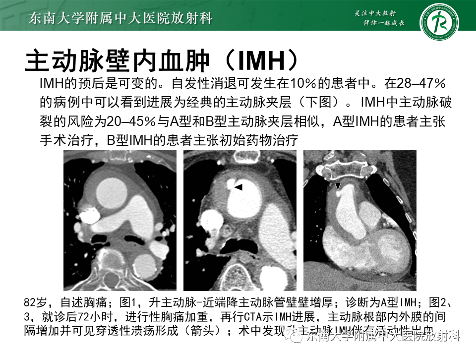 影像PPT - 【PPT】急性主动脉综合征-16