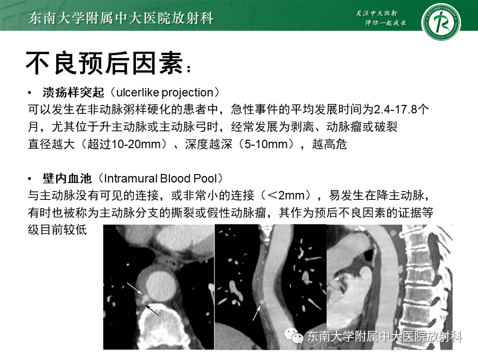 影像PPT - 【PPT】急性主动脉综合征-18