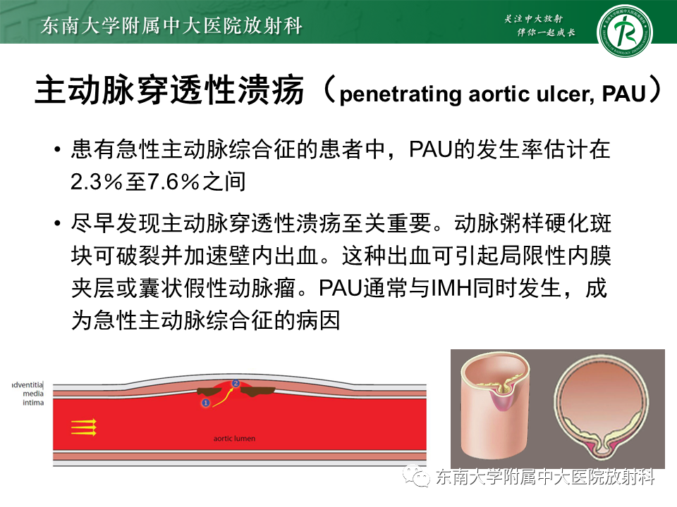 影像PPT - 【PPT】急性主动脉综合征-19