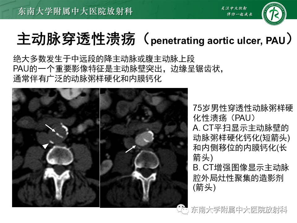 影像PPT - 【PPT】急性主动脉综合征-20
