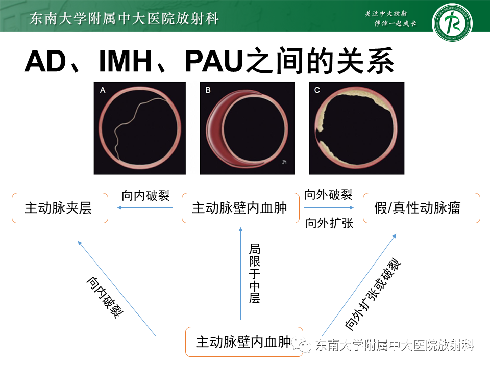 影像PPT - 【PPT】急性主动脉综合征-22